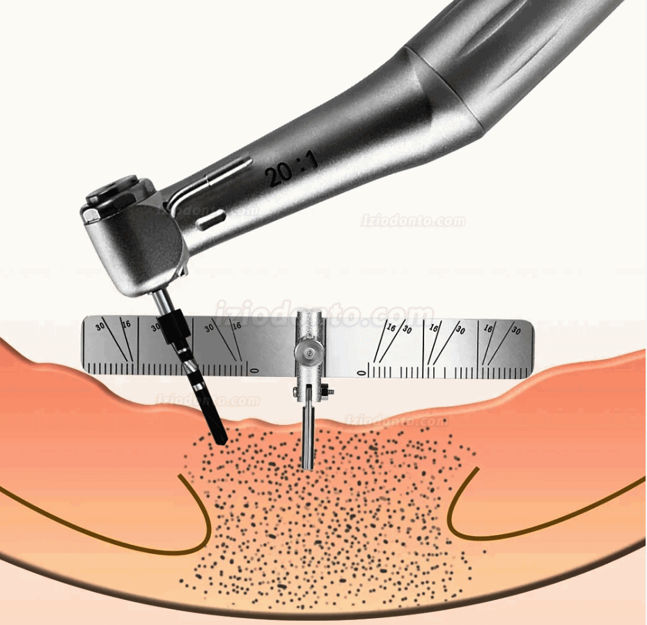 Guia de localização de implantes dentários medidor de régua e posicionamento de plantação